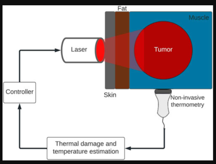 Tissue damage-tracking control system for image-guided photothermal therapy of cancer